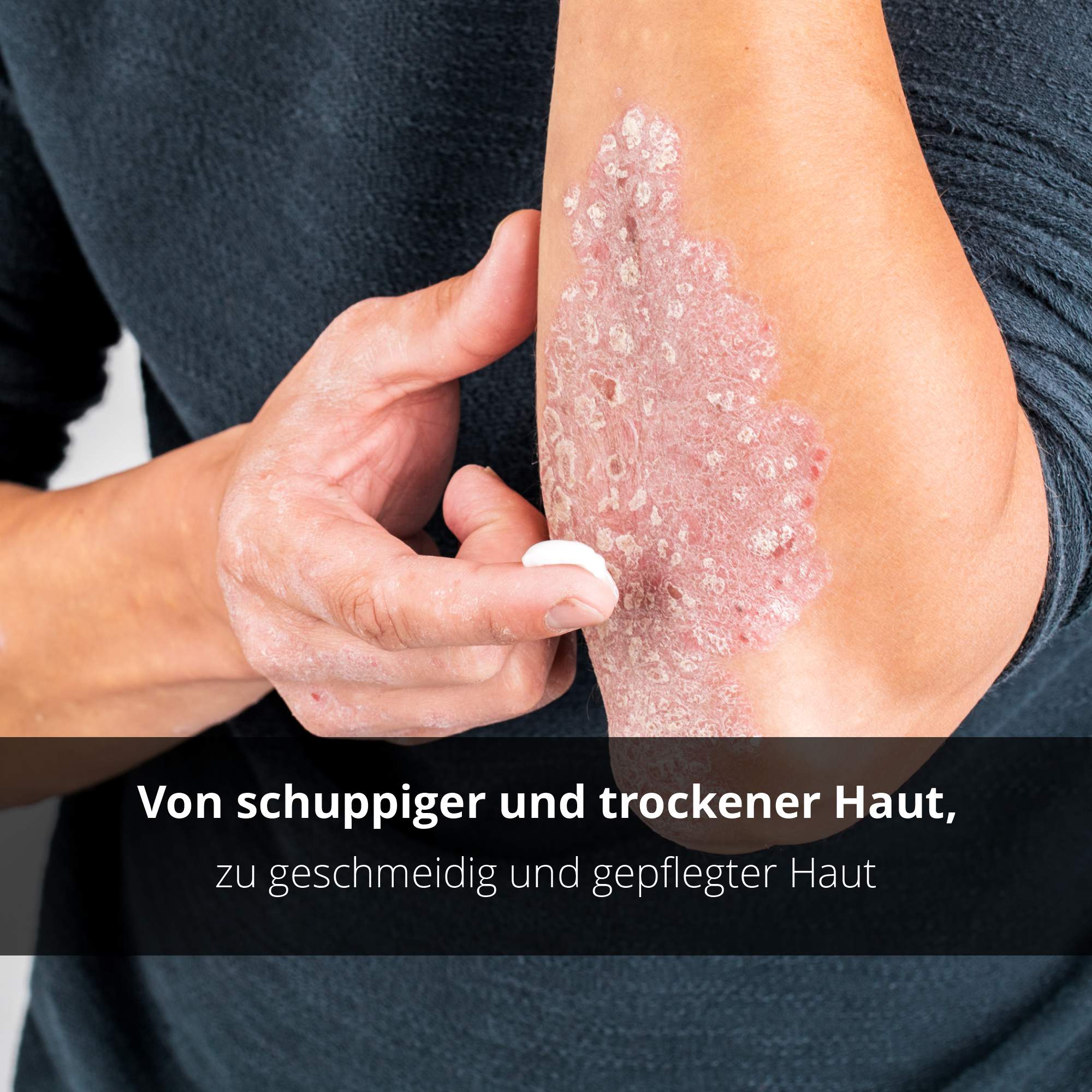 NeuroPsori Spezialpflege Creme - Pflege bei Neurodermitis und Schuppenflechte