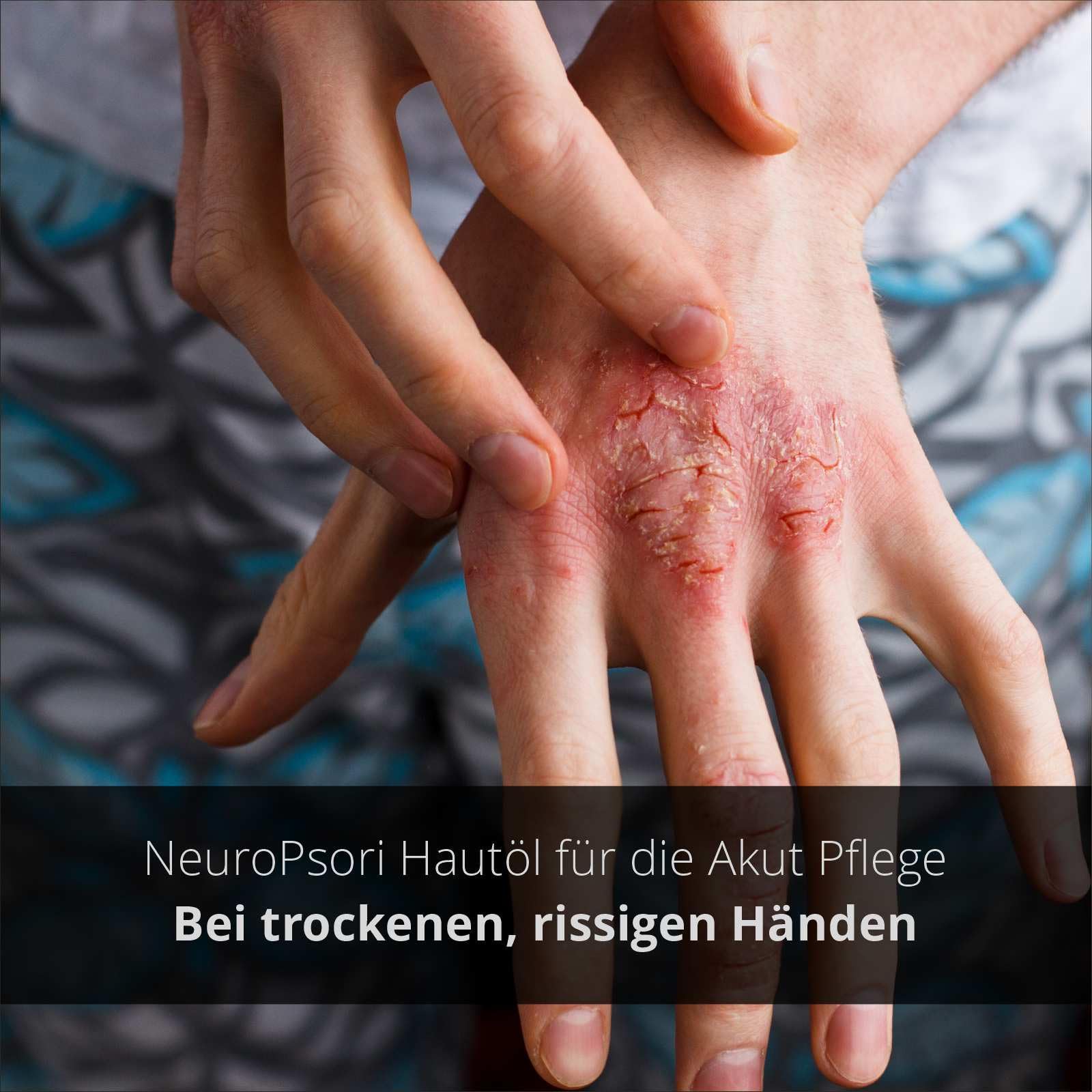 NeuroPsori BIO-Hautöl - mit Nachtkerzenöl, bei Neurodermitis und Schuppenflechte